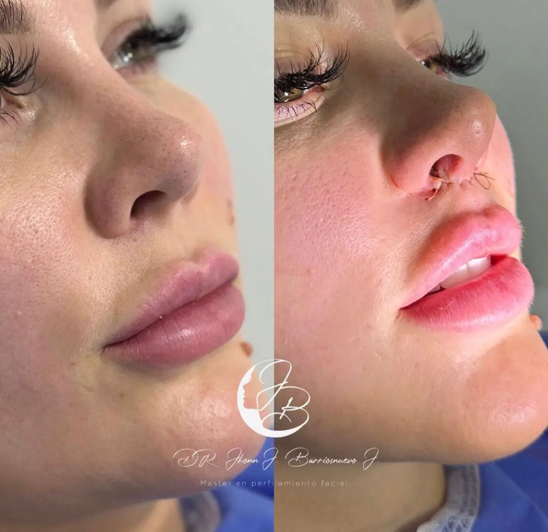 Lifting de Labio